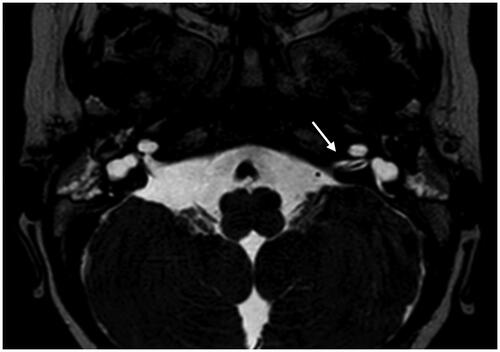 Figure 2. Magnetic resonance imaging of a case with vestibulocochlear nerve hypoplasia on the right side and bilateral inner ear malformation, Casselman grade 2 A. Arrow points to the left vestibulocochlear nerve (normal nerves on left side).