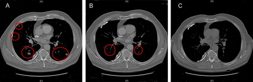 Figure 4.  Computed tomography of a patient with lung metastases responding (PR) to treatment. Baseline, A. Three months, B. Ten months, C.