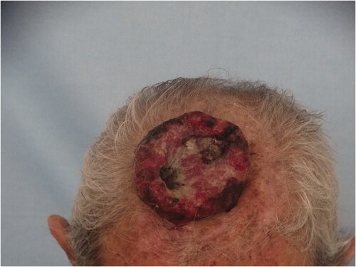 Figure 1. An ulcerated tumor located in the anterior of the vertex, fixed to the floor.