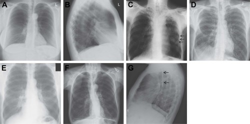 Figure 1 CXR findings in patients with COPD.