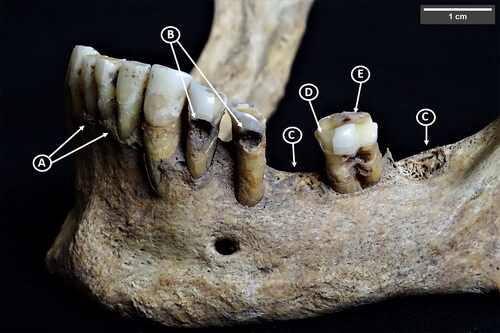 Fig 5 Mandible and accompanying dentition of HRU 4307. This exhibits signs of oral pathological lesions typical of what was observed in the Villamagna skeletal sample, including: a) likely gum disease due to alveolar recession accompanied by active remodelling and architectural changes; b) carious lesions (cavities); c) antemortem tooth loss; d) enamel chipping; and e) advanced tooth wear. Photograph by Trent Trombley.