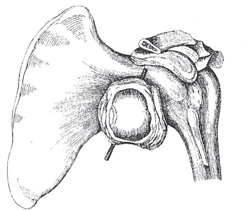 Figure 11. Unreduced fracture-dislocation of the proximal humerus. Reprinted from Thudichum (Citation1851) 100.