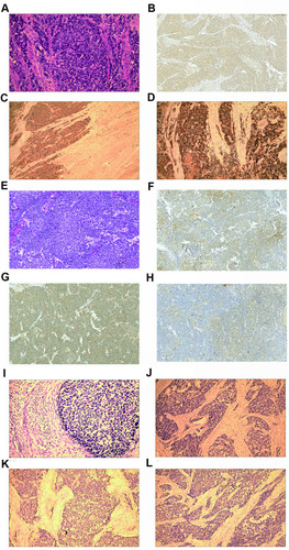 Figure 1 Pathological staining images for small-cell neuroendocrine carcinoma of the gynecologic tract (SCNCGT). (A) The small-cell neuroendocrine carcinoma of the endometrium (SCNCE) was characterized by small cells with scant cytoplasm (hematoxylin and eosin stain (H&E); magnification ×200). (B) The SCNCE was positive for chromogranin A and neuron-specific enolase (H&E; original magnification, ×100). (C) The SCNCE was positive for synaptophysin (H&E; original magnification, ×100). (D) The SCNCE was positive for chromogranin A (H&E; original magnification, ×100). (E) The small-cell neuroendocrine carcinoma of the ovary (SCNCO) was characterized by small cells with scant cytoplasm (H&E; magnification ×200). (F) The SCNCO was positive for neuron-specific enolase (H&E; original magnification, ×100). (G) The SCNCO was positive for synaptophysin (H&E; original magnification, ×100). (H) The SCNCO was positive for chromogranin A (H&E; original magnification, ×100). (I) The small-cell neuroendocrine carcinoma of the cervix (SCNCC) was characterized by small cells with scant cytoplasm (H&E; magnification ×200). (J) The SCNCC was positive for neuron-specific enolase (H&E; original magnification, ×100). (K) The SCNCC was positive for synaptophysin (H&E; original magnification, ×100). (L) The SCNCC was positive for chromogranin A (H&E; original magnification, ×100).
