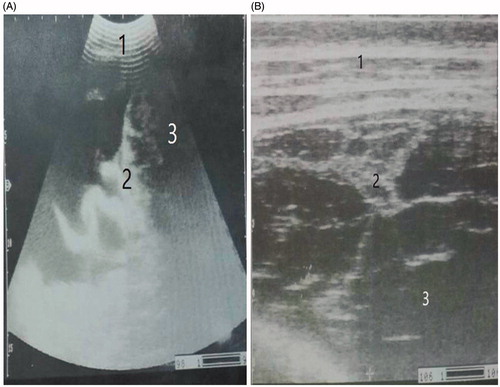 Figure 1. Ultrasonography of an abdominal cavity showing an echogenic fibrin interspersed with an anechoic exudate forming the fibrin network (fibrinous peritonitis) as detected by a convex transducer (A) and a linear transducer (B). 1. Abdominal wall. 2. Echogenic fibrin. 3. Anechoic exudate.