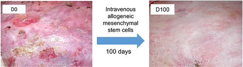 Figure 4 Treatment effect of intravenous allogeneic bone-marrow derived mesenchymal stem cells infusion in RDEB. The upper back of a 26-year-old patient with severe RDEB demonstrates improved wound healing and less inflammation 100 days after intravenous allogeneic mesenchymal stem cells infusion.