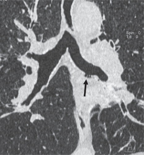 Figure 3 CT coronal reformation of a patient with symptoms of chronic bronchitis. Small bronchial diverticula (arrow) seen as outpouchings of the bronchial lumen visible along the left main bronchus.