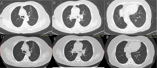 Figure 2 CT scan of the chest (lung windows) showing lung windows before (A–C) and after treatment (D–F). (A–C) Lung windows showing irregular high-density thickening of the tracheal wall (A), both stem bronchi, lobar, and proximal segmental bronchi (B), leading to tracheobronchial luminal stenosis and atelectasis of the right middle and lower lobe (C). (D–F) Lung windows showing the relieved tracheobronchial wall thickening and luminal stenosis; there was bronchial inflation sign in atelectasis.