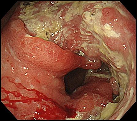 Figure 1 Endoscopic finding before treatment. On esophagogastroduodenoscopy before treatment, an irregular ulcerative tumor in the middle to lower stomach and the pyloric ring was constricted so that the scope could barely pass through it.