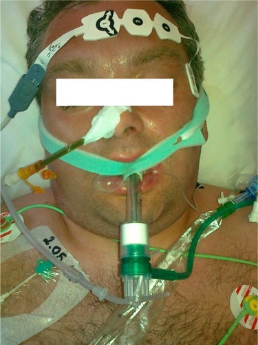 Figure 2 Presentation of Boussignac CPAP (Vygon, Ecouen, France) system during apneic test.
