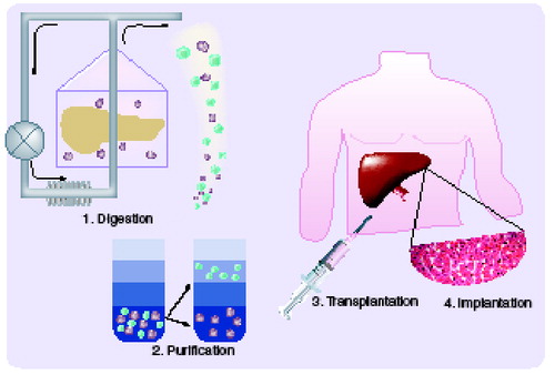 Figure 1. Schematic representation of the basic steps of islet transplantation.1. Retrieval of donor pancreas and isolation of islets by enzymatic and mechanical digestion. 2. Purification of islets using density gradient centrifugation. 3. Infusion of purified islets into the portal vein via percutaneous catheterization. 4. Implantation of infused islets in hepatic sinusoids.Modified from the University of Alberta Clinical Islet Transplant Program Citation[101].
