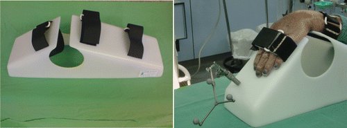Figure 1. Stable immobilization of the forearm was assured by a specially developed splint for the dorsal intervention made from radiolucent material. The tracker for the 2D and 3D navigation could easily be positioned on this splint.