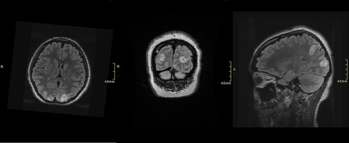 Figure 2. Axial (left), coronal (Middle), and sagittal (right) T2-weighted-fluid-attenuated inversion recovery (T2/FLAIR) MR images demonstrated hyperintensity within the bilateral medial parietal and occipital lobes at 70-h post-admission.