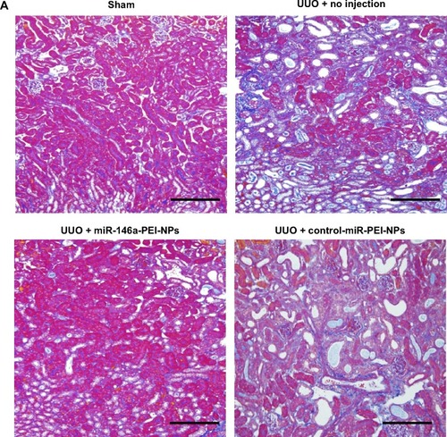 Figure 5 Effects of microRNA (miR)-146a-polyethylenimine nanoparticles (PEI-NPs) on fibrotic changes in obstructed kidneys.Notes: (A) Representative azan staining of obstructed kidney sections in each group (n=6). Areas with positive blue staining show collagen fibers. (B) Representative sirius red staining of obstructed kidney sections and quantitative analysis of fibrotic areas in each group (n=6). Values are mean ± standard error (error bars). *P<0.05. Scale bar 100 μm.Abbreviations: NS, not significant; UUO, unilateral ureteral obstruction.