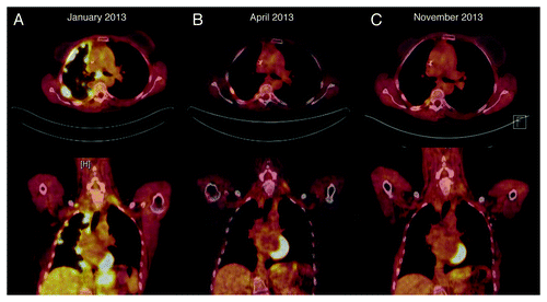 Figure 2. (A) PET/CT (positron emission tomography/computed tomography) scan prior to afatinib treatment. (B) Follow-up PET/CT scan after 2 and (C) 10 mo of afatinib treatment with complete anatomic and metabolic response.