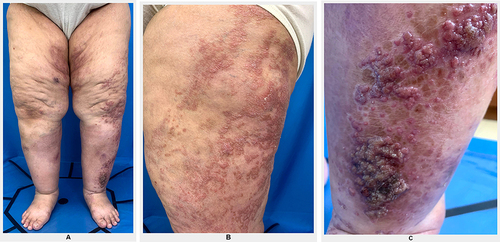 Figure 1 Clinical image of skin lesions before treatment. (A) Skin lesions on lower legs. (B) Erythematous plaques on left thigh. (C) Verrucous plaques on left lower leg.