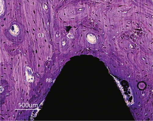 Figure 34. A 12-week close up of a HA-coated implant demonstrating loose HA particles (arrows) in the soft tissue outside thread peak as well as in bone remodelling cavities further away from the implant. Older cortical bone (OB) can be observed separated from younger bone by cement lines (CL). Note regions of more woven bone (WB) (immature) structure internalized in the remodelled bone. Toluidine blue routine histological staining.