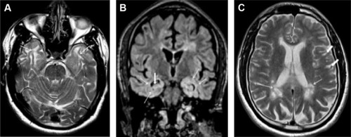 Figure 3 Brain MRI of Case no 7.