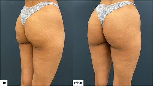 Figure 4 Case 2, Buttocks Beautification 3D. Standardized oblique images pre and 150 days post injection.