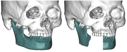 Figure 1. Virtual segmental osteotomy of the right mandible.