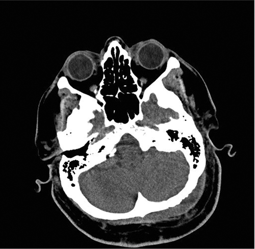 Figure 1a. CT scan showing soft tissue swelling suggestive of epidural abscess of left posterior fossa.