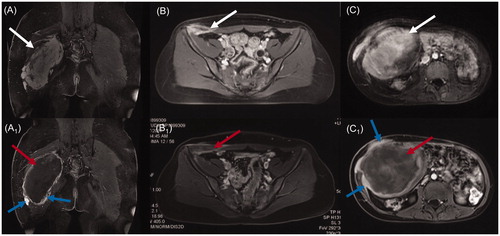 Figure 1. Contrast-enhanced MRI of three types of desmoid tumors (DTs). Before HIFU ablation, the areas of significant enhancement (white arrow) were shown in extra-abdominal DT (A), abdominal wall DT (B) and intra-abdominal DT (C). One week after HIFU ablation, non-perfused areas (red arrow) were observed within the extra-abdominal DT (A1), abdominal wall DT (B1) and intra-abdominal DT (C1), and the areas of peripheral enhancement representing residual tumors (blue arrow) were observed in the extra-abdominal DT (A1) and intra-abdominal DT (C1).
