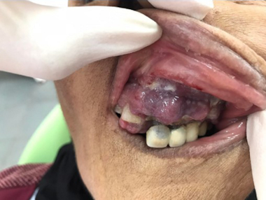 Figure 6. Ulcero-budding gum tumor with repression of the fixed prosthesis.