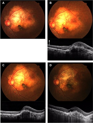 Figure 4 Photograph and spectral domain optical coherence tomography (SD-OCT) findings for case 2.