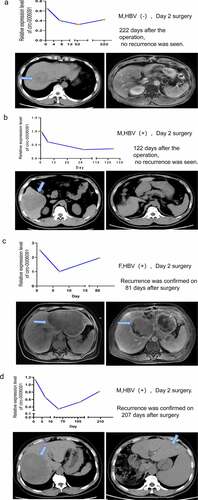 Figure 5. The monitoring of the prognosis and recurrence of HCC patients through the plasma level of hsa_circ_0006091. (a-d) The above panel respectively represents the expression level of hsa_circ_0006091 on the first day before the operation, the 7th day after the operation, and the subsequent follow-up. The below panel is the abdominal CTs of four HCC patients before and after surgery. The green arrow indicates the location of the tumor on the CT. Among them, the patients in Figure 5(a,b) showed no obvious signs of recurrence after the postoperative review. The patients in Figure 5(c,d) showed tumor recurrence after reexamination.