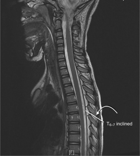 Figure 2 Magnetic resonance image of the thoracic spine and vertebral bodies showing technique for the measurement of the inclined skin to epidural depth at the T6–7 interspace.