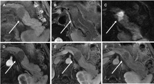 Figure 4 Magnetic resonance images of a 64-year-old woman with pancreatic neuroendocrine tumor Grade 3.Notes: Fat-suppressed liver acquisition with volume acceleration sequence. T1-(A) and T2-(B) weighted imaging, a well-defined mass (arrows) located in the body of pancreas shows hypo-intensity and slight hyper-intensity, respectively. Diffusion-weighted images shows the tumor (arrow) was hyper-intense (C). The tumor (arrows) shows persistent hypo-enhancement during the arterial (D), portal venous (E), and delayed (F) phase.