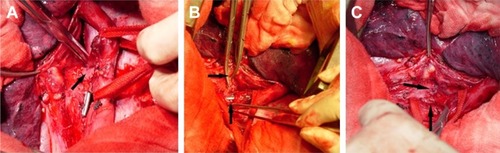 Figure 1 A 51-year-old female with esophagotracheal fistula for 7 months underwent division of the fistulous tract and closure of the trachea and esophagus.