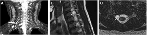 Figure 1 M, 37 months, right upper limb weakness for 3 months. Muscle strength was graded as I. EMG showed neurogenic damage to the right brachial plexus. Coronal MIP 3D-STIR SPACE image (A) displayed thickening of the right nerve root at C5 and C6 level (thick arrow), right nerve root loosening at C7 level (arrowhead), and right nerve root dissection at C8 level (thin arrow). Sagittal (B) and axial (C) T2WI showed pseudomeningocele at C8 level (thin arrow).