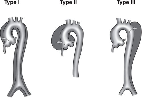 Figure 3A Debakey classification.