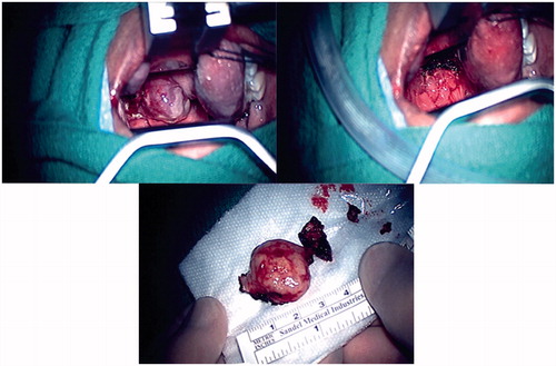 Figure 3. Operative images of the lingual thyroid sitting on the posterior tongue base viewed through the oropharynx and the excised lingual thyroid.