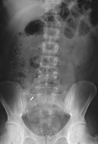 Fig. 1.  Abdominal radiograph revealing multiple flecks in the gastrointestinal tract of the patient.
