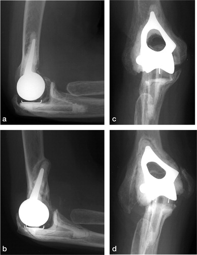 Figure 6. Lateral and anteroposterior (AP) radiographs of two elbows with small humeral components, taken 5 years after insertion.A.Lateral view of a well-fixed humeral component.B.Lateral view of a migrating humeral component with anterior tilt.C.AP view of a well-fixed humeral component.D.AP view of a migrating humeral component (with a fracture of the medial epicondyle). The ulnar components in all figures show radiolucent lines, but no aseptic loosening was seen.