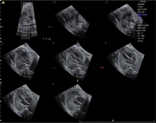 Figure 4 Tomographic ultrasound imaging showing parallel slices of cardiac planes along the fetal thorax, thus demonstrating the planes of three vessels and trachea, five chambers, and four chambers.