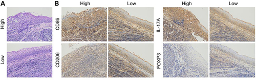 Figure 1 (A) H&E staining was used to detect the pathological state of the adenoids of AH patients. (B) IHC based detection of the expressions of CD86, CD206, IL-17A and FOXP3.