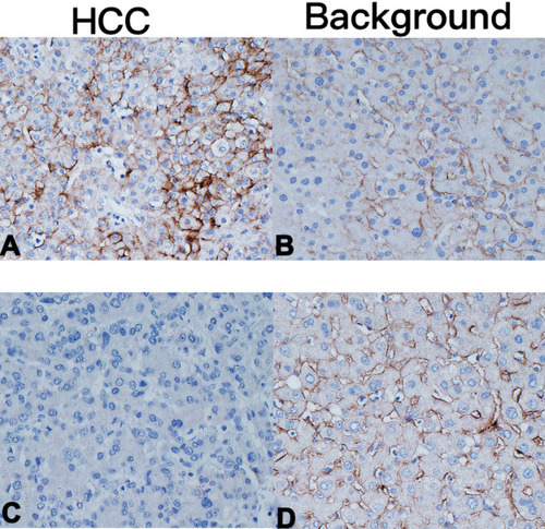 Figure 7 (A and B) An HCC patient with iso- or hyperintense images at the HB stage. The expression of OATP1B3 is significantly higher than that of the background liver. (C and D) An HCC patient with hypointense images at the HB stage. The expression of OATP1B3 in HCC is basically not expressed and is significantly lower than that of the background liver.
