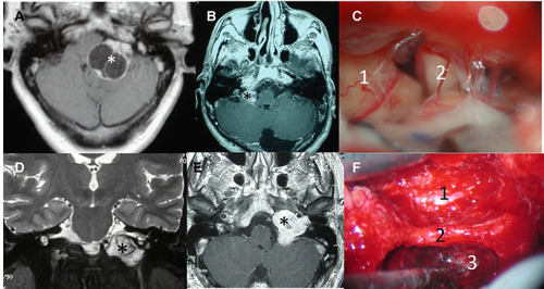 Figure 3 Surgical approaches in lower cranial nerve schwannomas. (A) T1-weighted MRI with contrast of a Type A cystic vagal schwannoma (*). (B) T1-weighted MRI with contrast of a Type A vagal schwannoma (*). (C) Retrosigmoid approach of the last case showing the tumor (1) and the cochleo-vestibular nerve (2). (D) Coronal T2-weighted MRI delimiting a Type B lower cranial nerve schwannoma in the jugular fossa (*). (E) Axial T1-weighted MRI with contrast of the same tumor (*). (F) Modified infratemporal fossa approach type (A) internal carotid artery (1), third portion of the facial nerve (2), tumor in the jugular fossa (3).