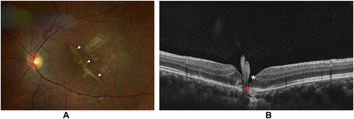 Figure 1 Choroidal rupture. (A) A color fundus photo of the left eye demonstrating an oblique pale streak as highlighted by white arrowheads. (B) Ocular coherence tomography demonstrating full thickness retinal discontinuity, as shown by a white asterisk, including the RPE hyperreflectance and disorganization, as shown by a red asterisk.