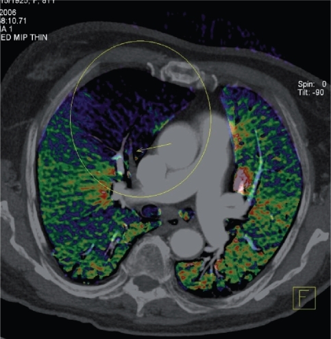 Figure 6 Example of a reconstruction from dual-energy CT in a patient presenting with an exacerbation of chronic obstructive pulmonary disease. Axial image with superimposed color-coded iodine distribution shows the lung perfusion and a defect (blue-black) caused by an occluding embolus in the right descending artery (arrow). (Courtesy of Christian Fink, MD, Munich, Germany).