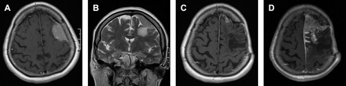 Figure 3 Preoperative MRI examination in contrast-enhanced T1-weighted axial (A) and T2-weighted coronal (B) planes of a convexity meningioma in a 72-year-old woman with Simpson grade I resection of an atypical meningioma (WHO grade II). No postoperative radiotherapy was used. MRI examination performed 18 months after surgery revealed a small recurrence shown in the axial contrast-enhanced T1-weighted image (C). Cyberknife radiotherapy was used. MRI examination performed 42 months after surgery showed further tumor growth (D) and Cyberknife radiotherapy was reapplied. The patient was alive at the last follow-up contact (50 months post-surgery).