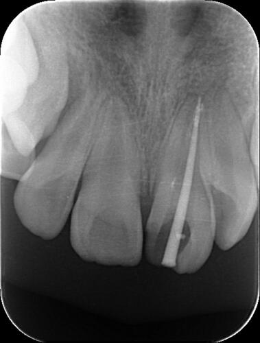 Figure 3 Working length determination radiograph of tooth 21.