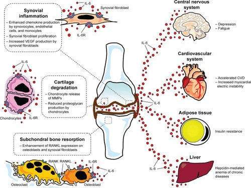 Figure 2 The role of IL-6 in the pathogenesis of joint damage and extra-articular manifestations in rheumatoid arthritis.