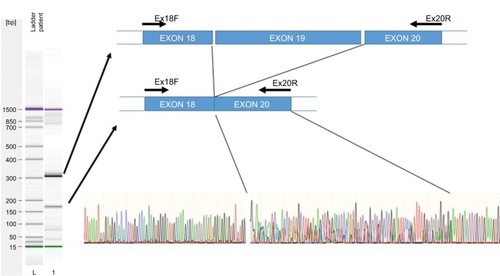 Figure 2 Exon skipping sequence.Notes: Left: Electrophoresis of amplified cDNA from peripheral blood mononuclear cells of a patient carrying the 2242+1G>T variant. Right, upper: Graphic representation of skipping of exon 19. Right, lower: Sequence electropherogram using the primer Ex18F. A double sequence is observed for 85 nucleotides corresponding to overlapping of exons 19 and 20.