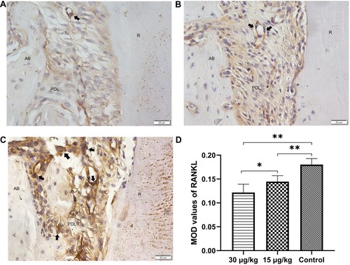 Figure 9 Expression of RANKL in the compression side of distopalatal root of maxillary molar.