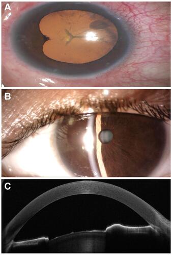 Figure 1 Pre-operative examination of both eyes. (A) Anterior segment picture of the right eye (RE) shows posterior synechiae, peripheral iridotomy, and cataractous lens. (B) Slit-lamp examination of the left eye shows narrow anterior chamber. (C) Anterior segment-optical coherence tomography of the RE shows a closed iridocorneal angle.