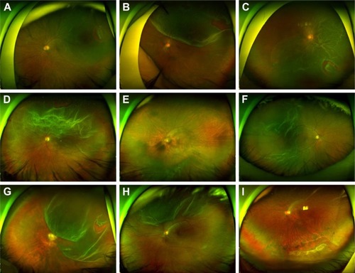 Figure 7 Cases of rhegmatogenous retinal detachment less suitable for SB alone. PVD, bullous retinal detachment, and a relatively large retinal tear are noted.