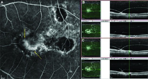 Figure 1 (A) Fluorescein angiography of the left eye demonstrating two chorioretinal scars (white arrows) and a classic choroidal neovascular membrane (yellow arrows). (B) Spectral domain optical coherence tomography (Spectralis® HRA-OCT, Heidelberg Engineering, Inc., Carlsbad, CA, USA) point-to-point registration before and after the administration of the intravitreal injection of ranibizumab, demonstrating a thick, hyper-reflective, and taut posterior hyaloid, partially detached from the posterior pole exerting traction on the fovea. The steep V-shaped hyaloids curve and the thickened cystoid fovea are suggestive of vitreomacular traction (before), which demonstrate a resolution and reduction of macular thickness (after). (C) Spectral domain optical coherence tomography point-to-point registration at the next level, showing the release of the vitreous traction.